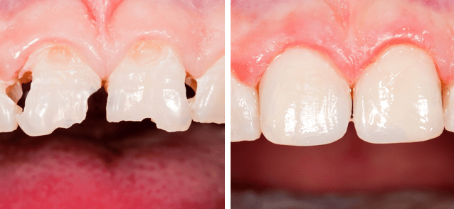 художественная реставрация зубов